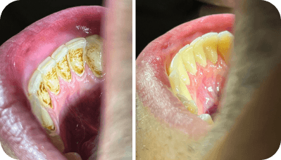 Prevenção e Limpeza