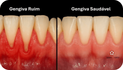 Tratamentos Periodontais