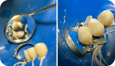 Restaurações Dentárias